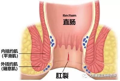 肛周疼痛的病因与鉴别