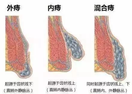 什么是混合痔及临床表现？