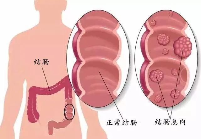 肠道有息肉该不该切除