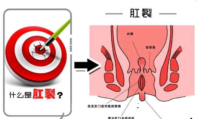常被人忽视的肛肠病——肛裂