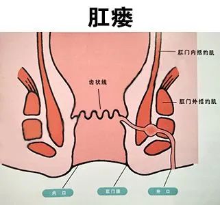患了肛瘘怎么办