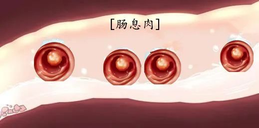 肠息肉的病因