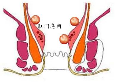 肛门部位异常,长了的多余东西怎么回事
