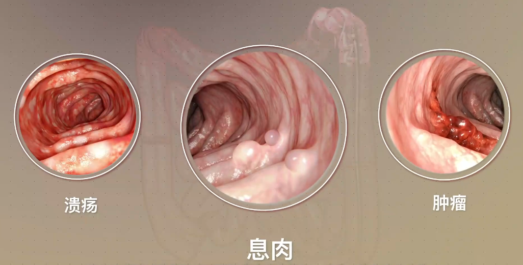 发现肠息肉该怎么办
