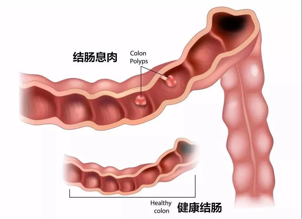 肠息肉怎么治疗
