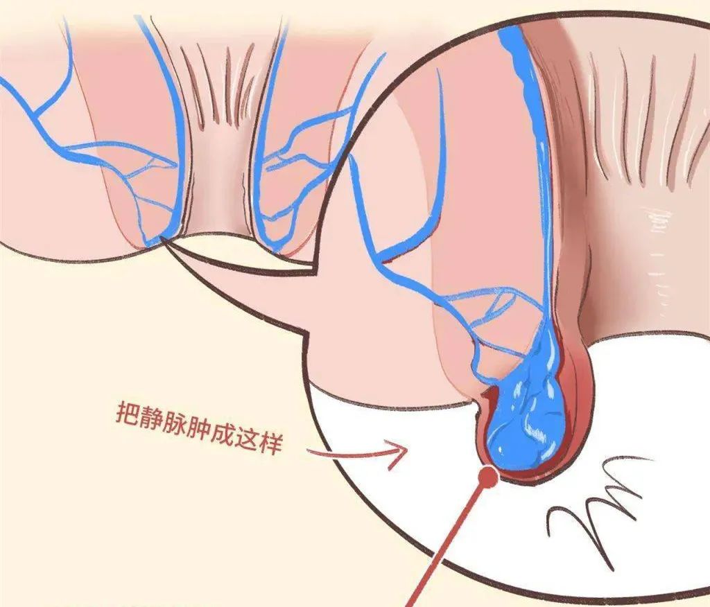 痔疮越长越大越长越多怎么办