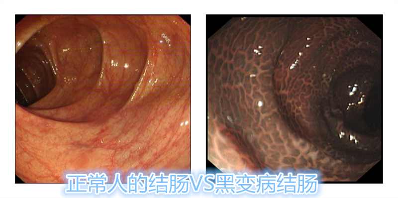 56岁女子服用清肠茶2年多，现在肠子变黑了……