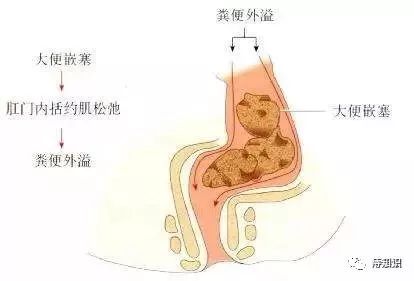 肛肠术后的一个严重并发症:直肠粪嵌塞