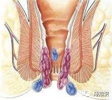 痔疮治疗最有效最便宜的方法