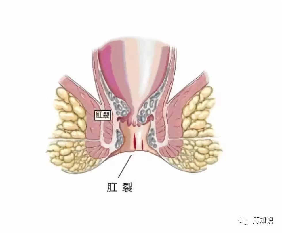 什么肛裂需要做手术？肛裂的手术方式有哪些？