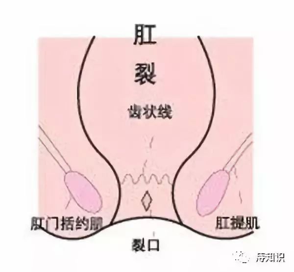 不同肛裂手术的适应症和优缺点