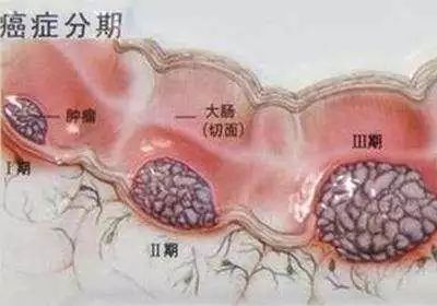 大肠癌是怎么回事