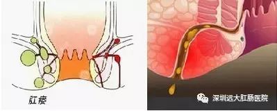 肛瘘是怎么形成的