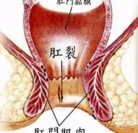 肛裂不能久拖不治
