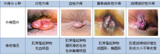 外痔的病因有哪些?