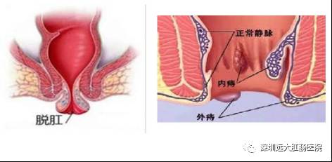 痔疮和脱肛的区别