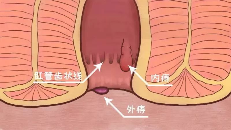 为什么有的痔疮疼,有的不疼?