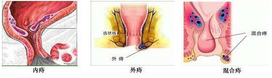 混合痔不及时治疗的危害