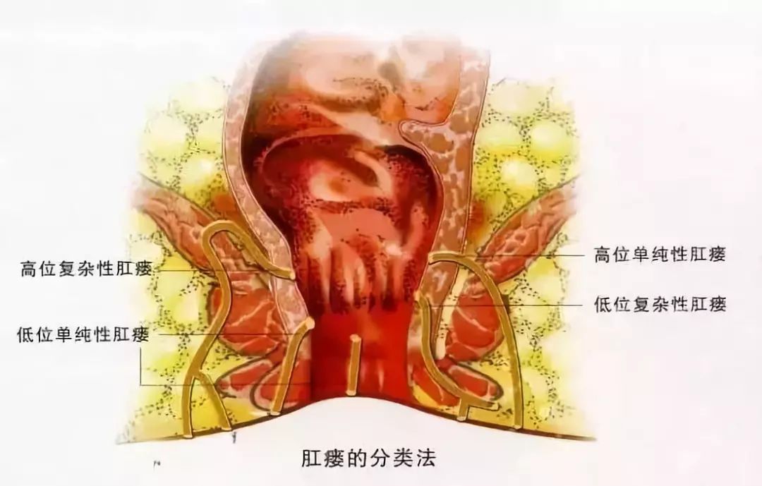 肛瘘的症状和危害