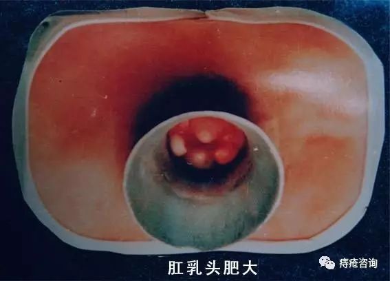 肛乳头肥大是什么意思