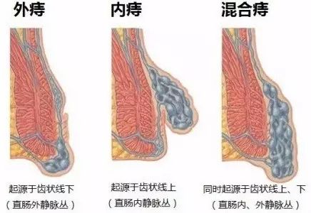 痔疮的日常防护措施有哪些