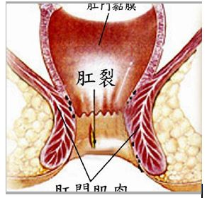 肛裂出血怎么办