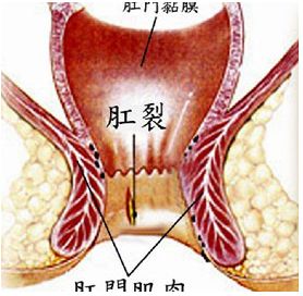 急性肛裂怎么治疗