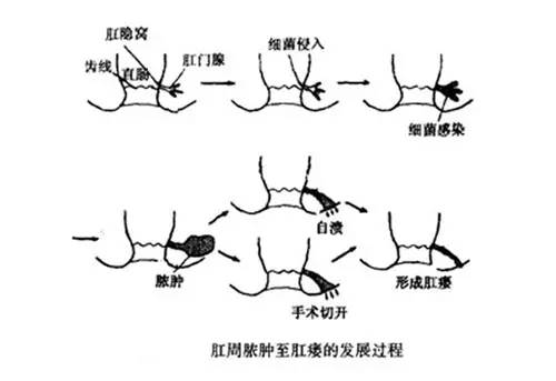 什么是肛周脓肿